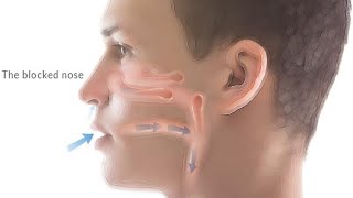 ACUPUNCTURE TREATMENT FOR BLOCKED NOSE (NASAL CONGESTION/CHRONIC SINUSITIS)