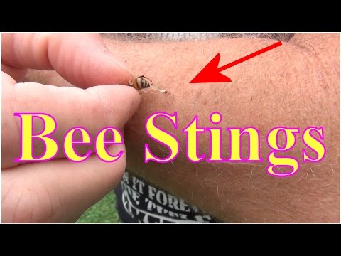 Bee Stings! Ouch, Stung By A Honey Bee. Now What?