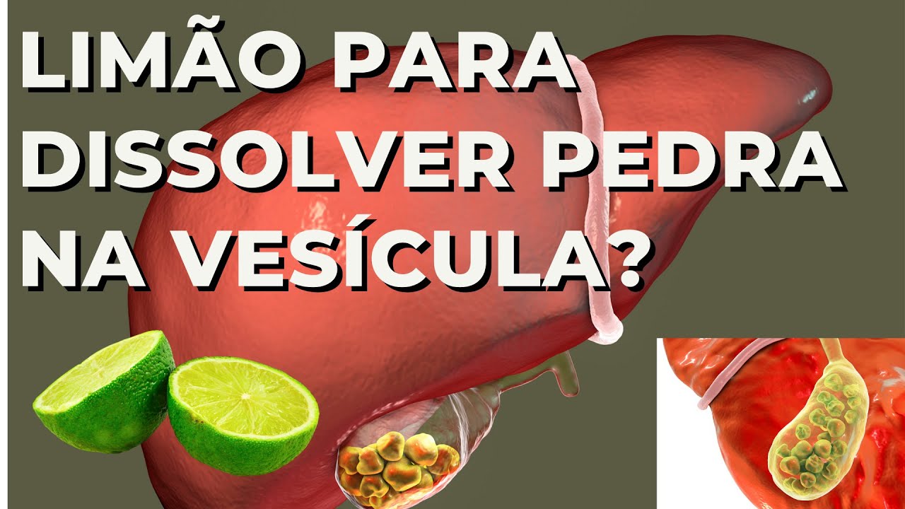 Limão dissolve pedra na vesícula? Será?