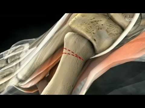 Hallux Valgus Operation (NDR Beitrag)