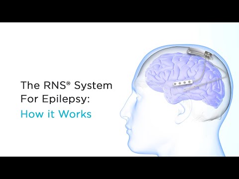 NeuroPace: How the RNS System Works