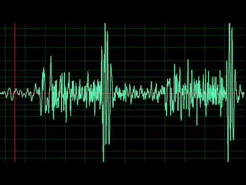 Mitral Regurgitation Tricuspid Regurgitation- normal speed