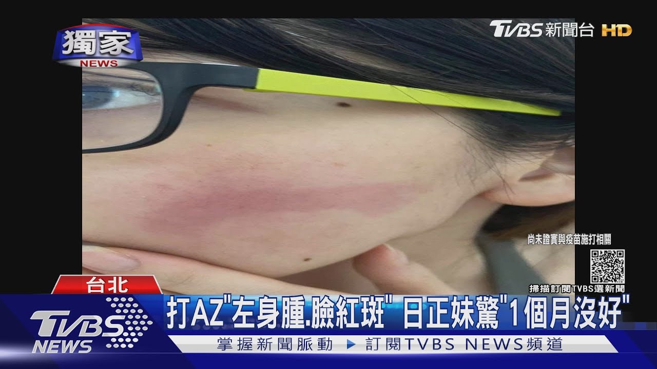打AZ「左身腫、臉紅斑」 日正妹驚「1個月沒好」