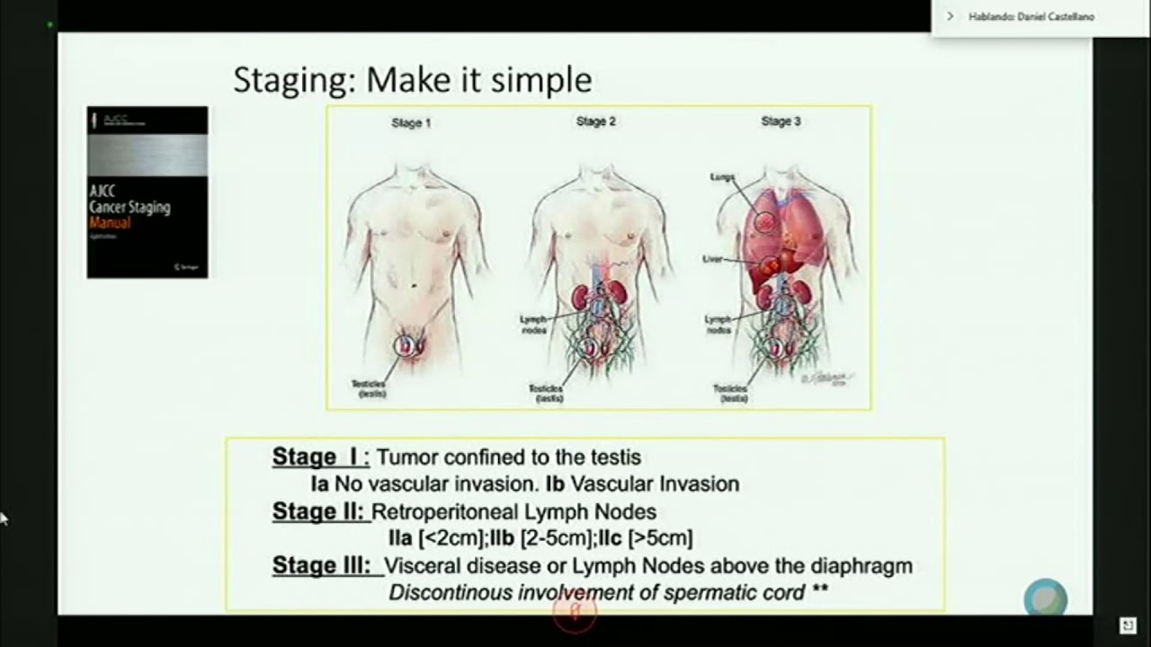 CLOC - Tratamiento de Tumores Germinales Testiculares, Dr. Daniel Castellano