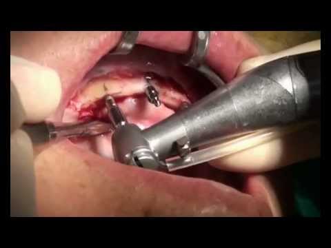 4 Mini Dental Implants supported Lower Overdenture in POOR BONE CASE (LIVE SURGERY)