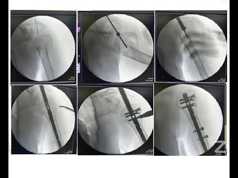 IM Nailing in Proximal Humerus fractures: Michell Ruiz, MD