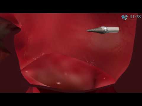 Cum se face : Mitraclip pentru regurgitarea mitrala | ARES