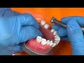 Adex Full Metal Preparation Bridge Tooth 3