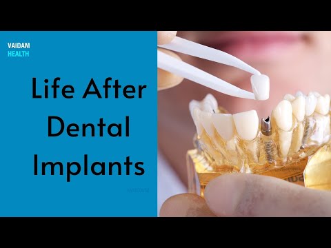 Life After Dental Implants