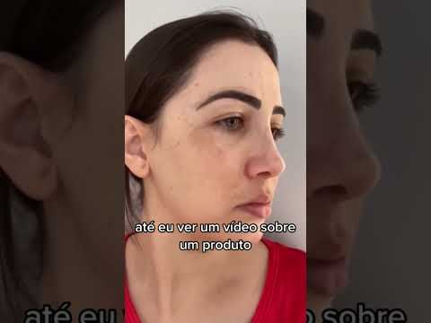 Clareador de manchas e melasma sem efeito rebote resultado garantido #melasma #manchasnorosto