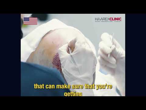 New Transformation Story - Haarex Clinic