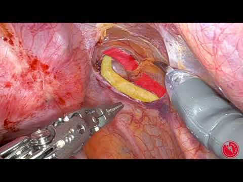 Robotically Assisted Laparoscopic Uterine Artery Clip