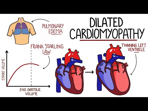Dilated Cardiomyopathy Made Easy (DCM)
