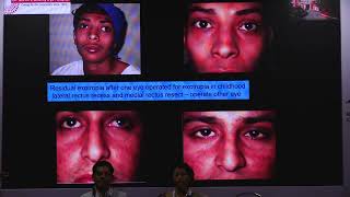 AIOC2024 - IC51 - Dr.Shubhangi Bhave - Again and again and again...Re-surgery in Strabismus....
