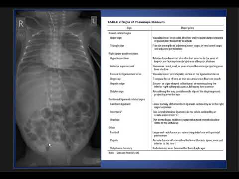 Case Discussion : Pneumoperitoneum.
