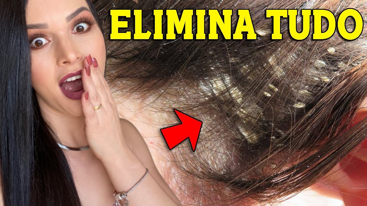 COMO TIRAR AS CASQUINHAS ou CASPA APÓS PROGRESSIVA OU SELAGEM!!! COURO CABELUDO DESCAMANDO