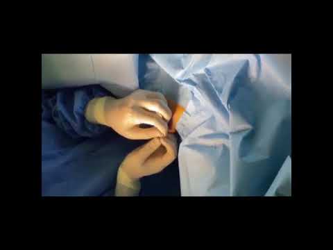Easy way to remove JJ stent from Bladder than Cysposcopy