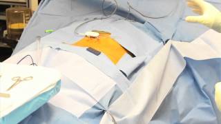 Spinal Cord Stimulator Implant