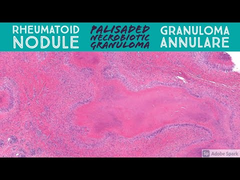 Rheumatoid Nodule & Granuloma Annulare: Palisaded Necrobiotic Granuloma Pattern  Dermatopathology