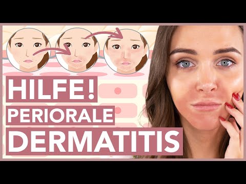 Periorale Dermatitis – Was hilft schnell und effektiv?