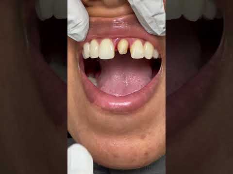 Amazing Invisible Dentistry with a Front Crown .... Perfect Match 😊