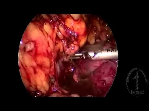 Transvaginal Nephrectomy - Dissection 2