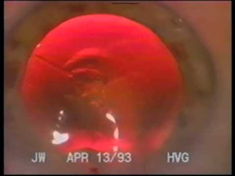 Rôle du produit viscoélastique dans la chirurgie de la cataracte