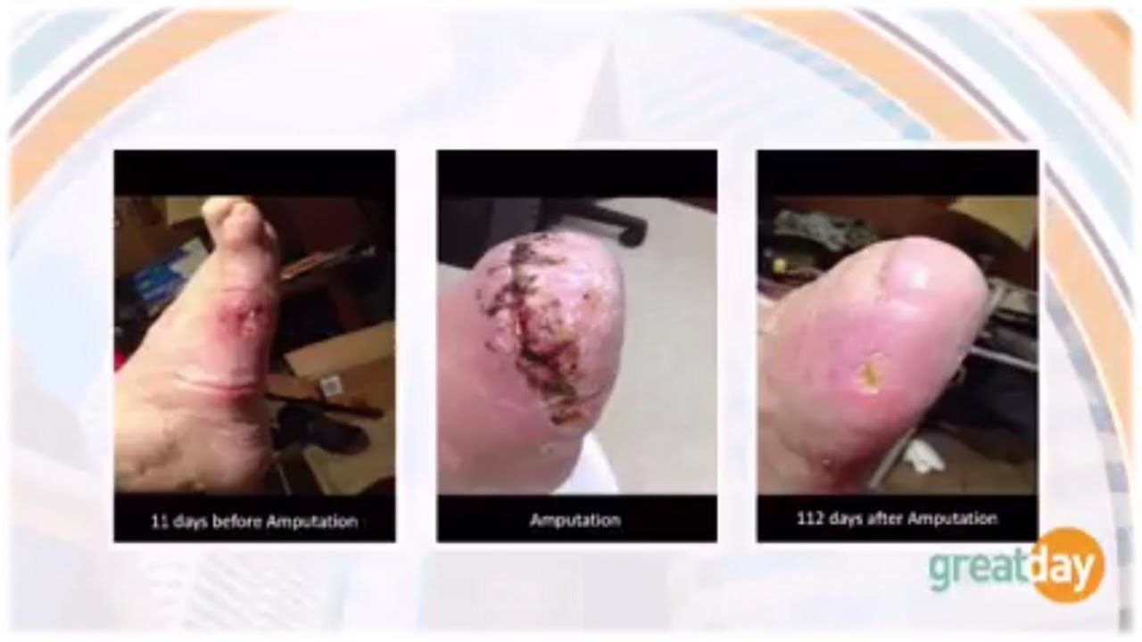 Diabetes Relief - Dr. Stanley Lewis -  GDH 7/11 Segment