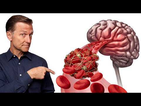 Find Out How to Predict a Silent Stroke When There Are NO SYMPTOMS Present