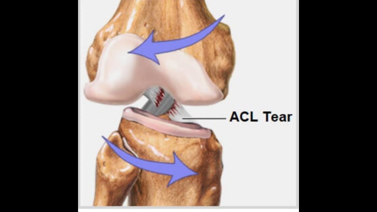 ACL लिगामेंट माहिती मराठीत