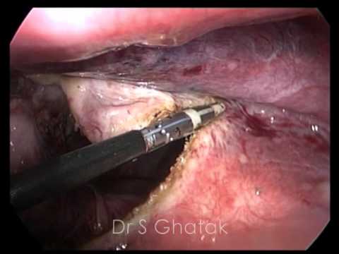 Laparoscopic deroofing of Liver Cyst