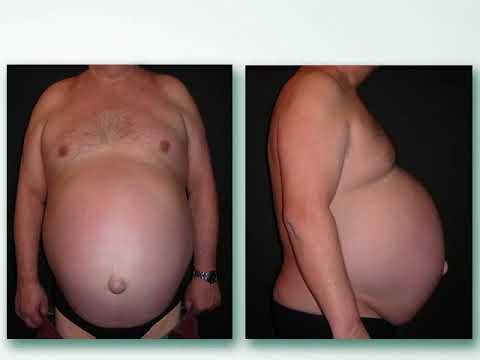 Pancia: oltre al grasso sottocutaneo esiste il grasso viscerale, ecco la differenza