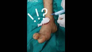 Ankle Block