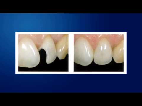 Calgary Dentist on Amalgams