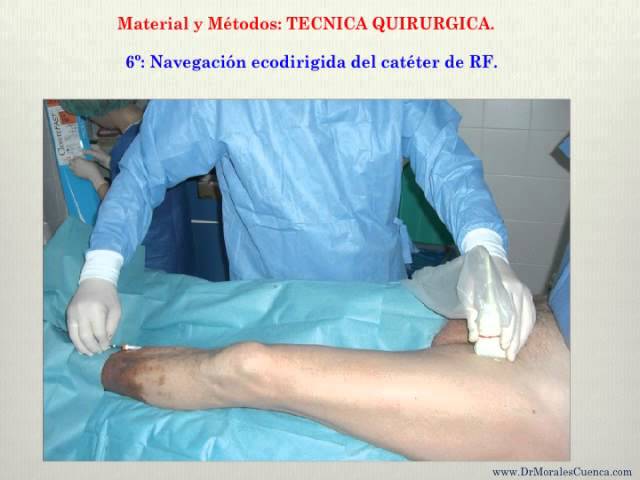 Sensación de pulso en el muslo izquierdo