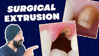 Surgical Extrusion Technique Update - Alternative to Ortho Extrusion or CLS - PDP249
