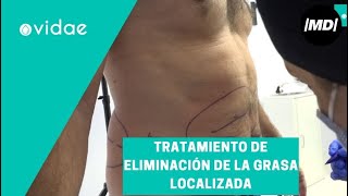 Cómo eliminar la grasa localizada