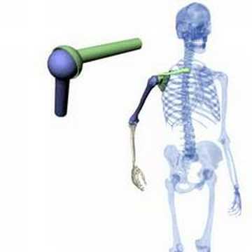 Schmerzen im Kind Ersatz der Gelenke bei der rheumatoiden Arthritis