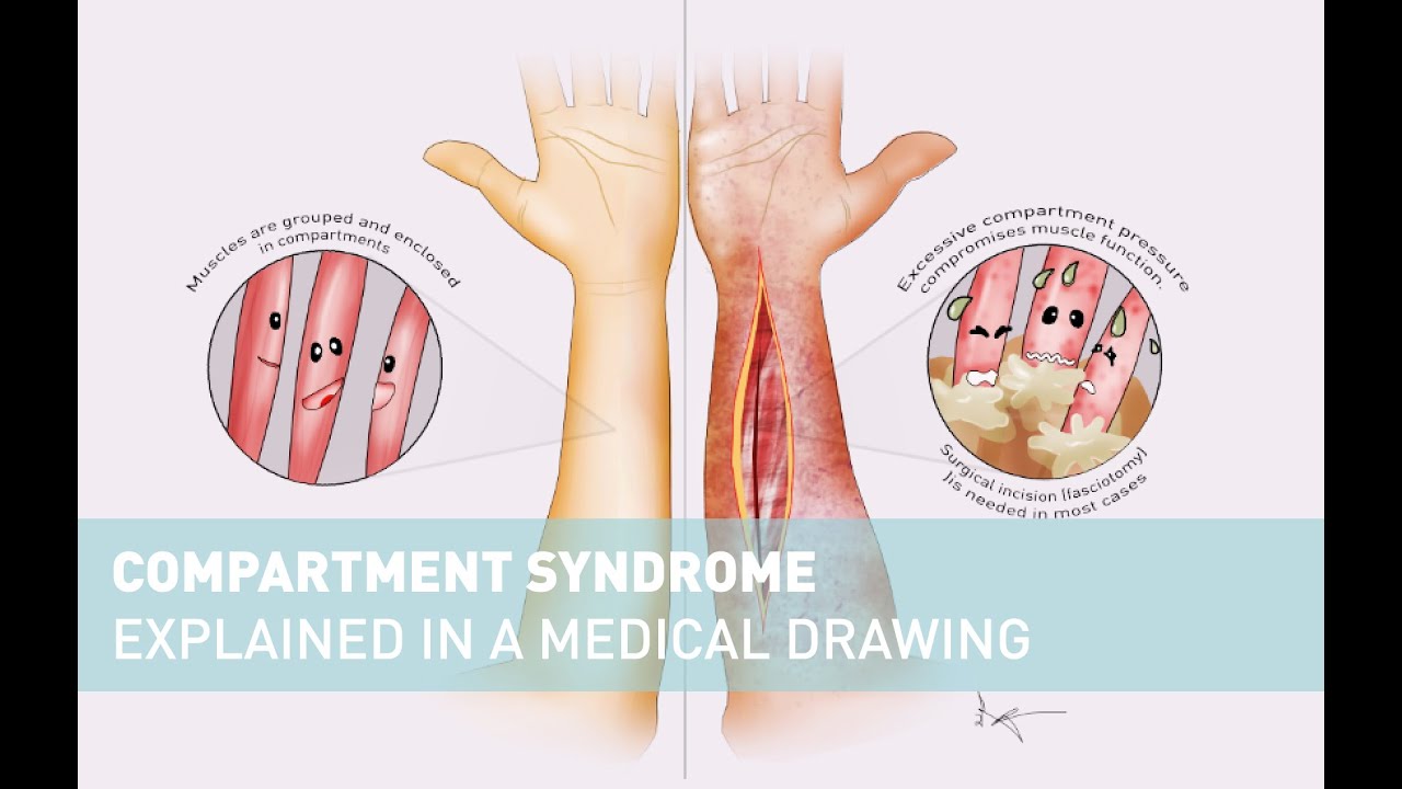 How I created this Medical Illustration - Compartment Syndrome