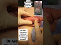 Penile Enlargement Surgery With Excellent Results Dr Araz Bayramov Www Penilenlargement Com