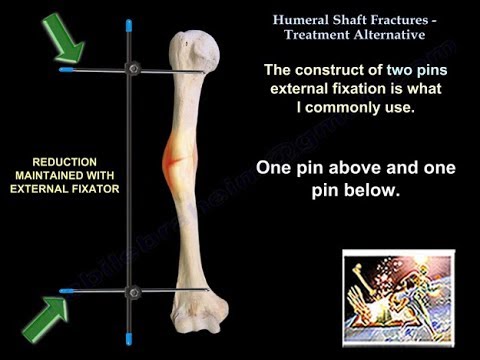 Humeral Shaft Fractures Treatment Alternative - Everything You Need To Know - Dr. Nabil Ebraheim