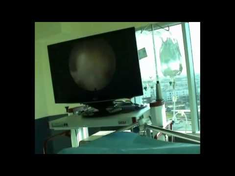 Robert Saftic (Vertebris Spine) explaining endoscopic discectomy