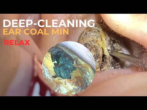Earwax as Big as a Coal Mine – Extreme Ear Cleaning -ARMR