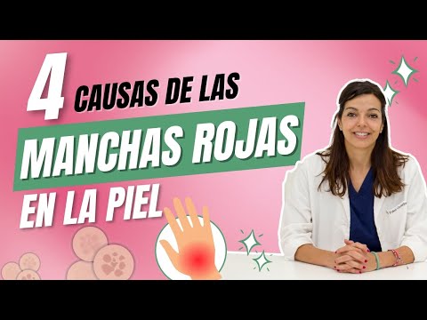 4 Causas de las Manchas Rojas en la piel