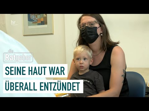 Atopic Dermatitis: How a Drug Changed Ruben's Life | Health Maker 4/5 | the counselors