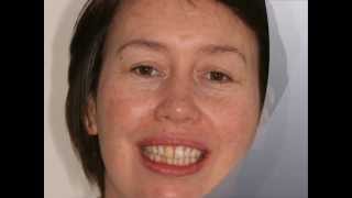 preview picture of video 'Brightside Dental - Six Month Smiles Teeth Straightening - Bounds Green Dentist'