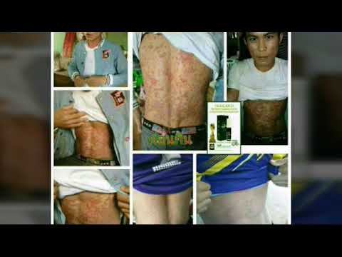 กลากที่ดีที่สุด Butakova สำหรับการรักษาของโรคสะเก็ดเงิน