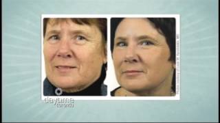 Daytime Toronto - Dr. Sean Rice - Laser Treatments and Chemical Peels