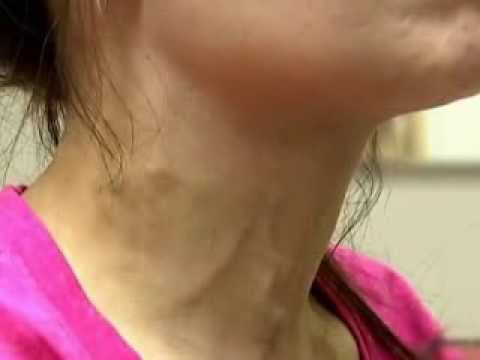 Giant C-V Waves of Tricuspid Regurgitation | NEJM