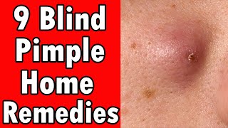 9 Home Remedies For A Blind Pimple